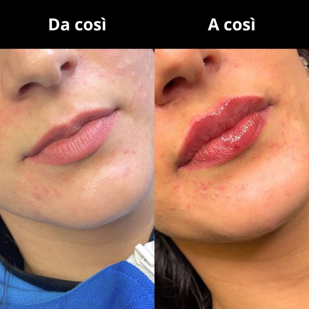 prima-e-dopo-filler-labbra-Med360-4.jpg